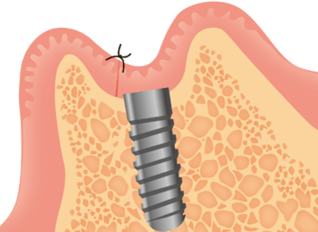 インプラント体の埋入