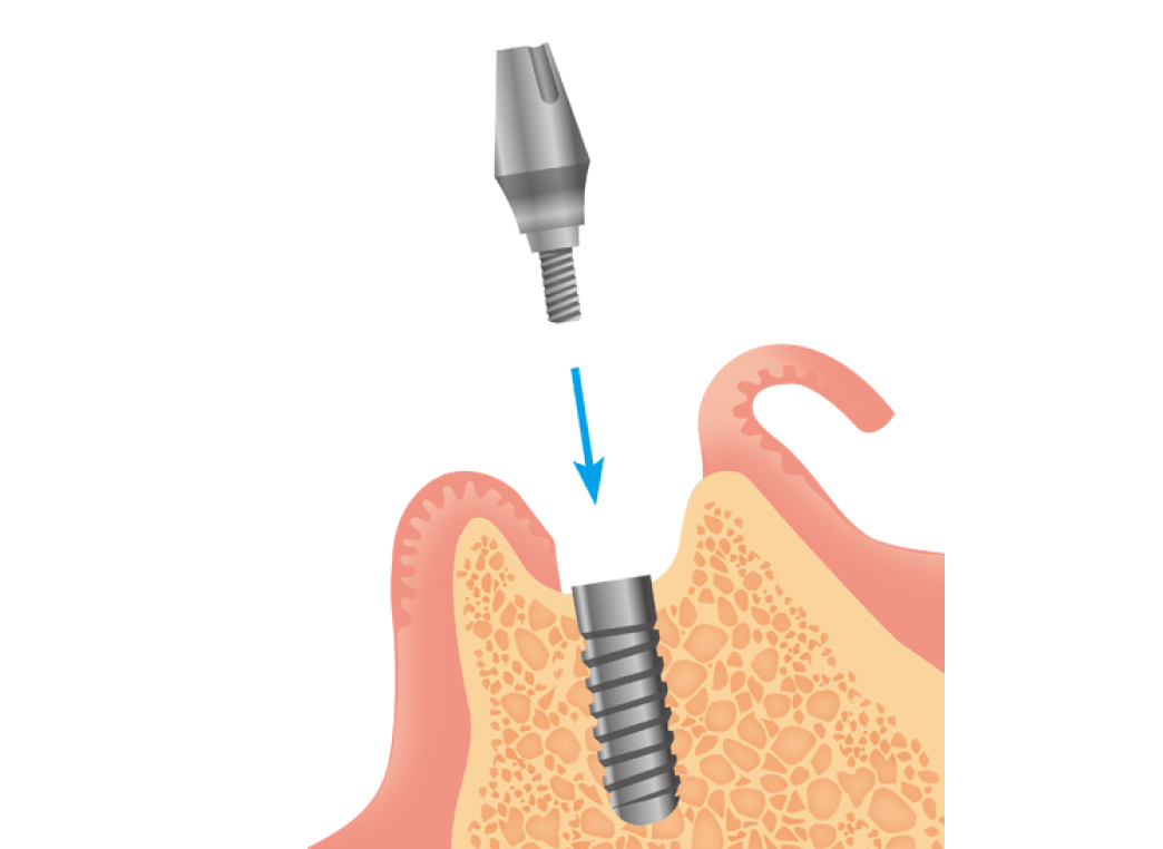アバットメントの装着