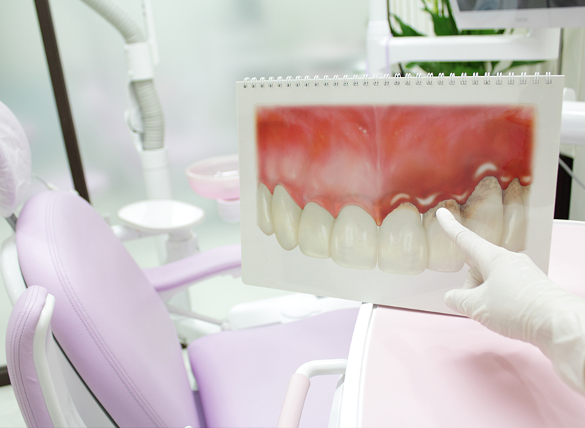 インプラント周囲炎