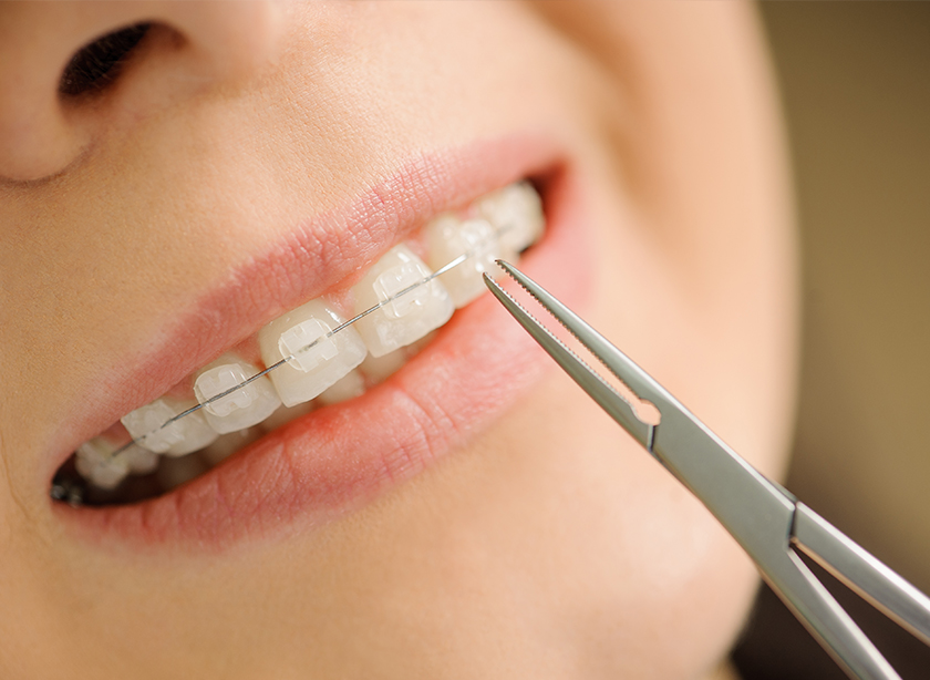 矯正装置の装着